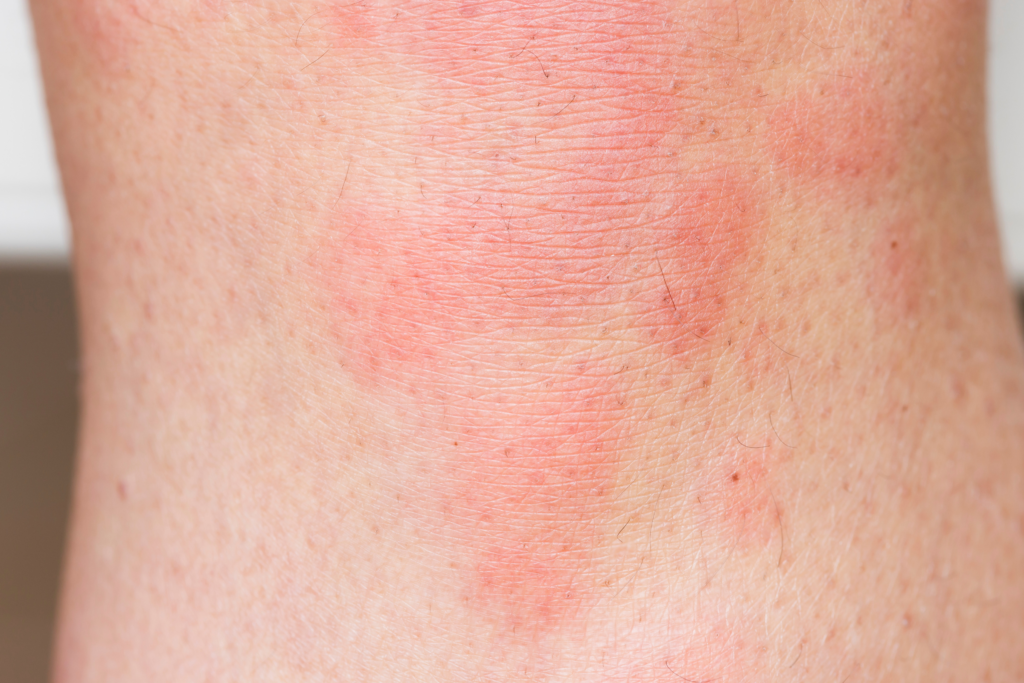 Dermatitis and allergies